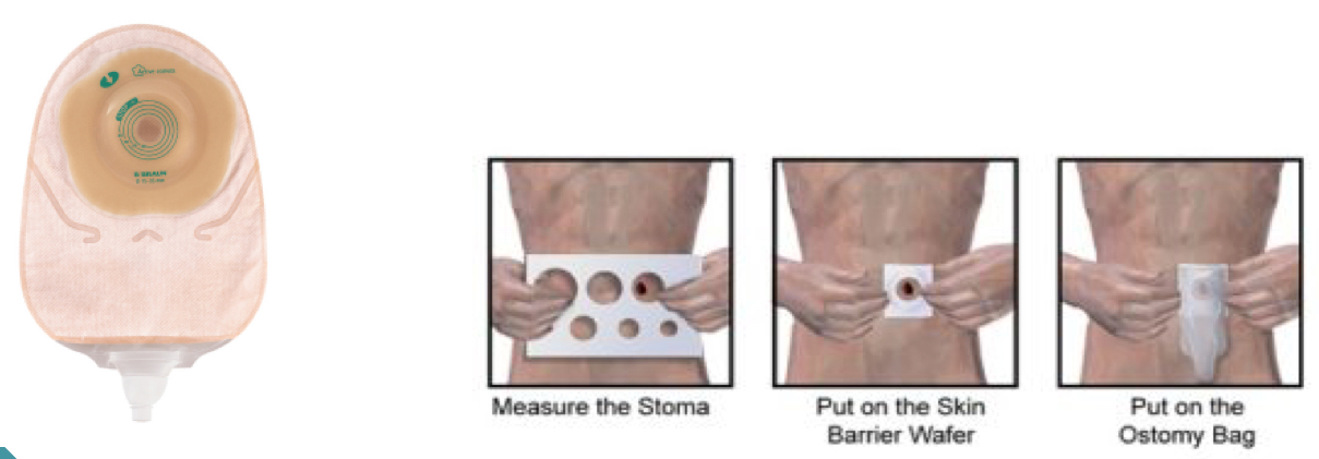 <p><span>urgically created opening on the abdomen that allows bodily waste to exit the body when the usual path is blocked or cannot function properly</span></p><ul><li><p>Example: ileostomy</p></li></ul><p></p>
