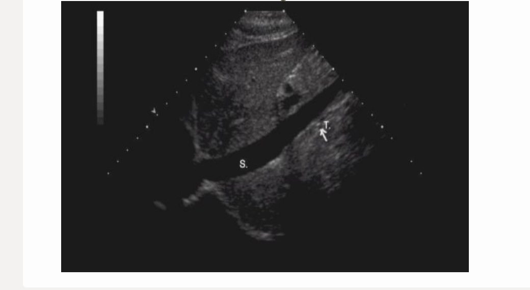<p>letter t is </p><p>.</p><p>a) left renal artery</p><p>b) right renal artery</p><p>c) IVC</p><p>d) superior mesenteric artery</p>