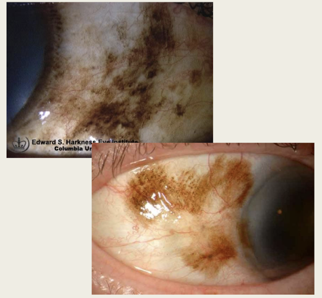 <p>flat irregular brown lesion(s) on any part of the conj (Pal, bulb, fornix)</p><p>Unilateral&nbsp;</p><p>May be uni or multi focal</p>