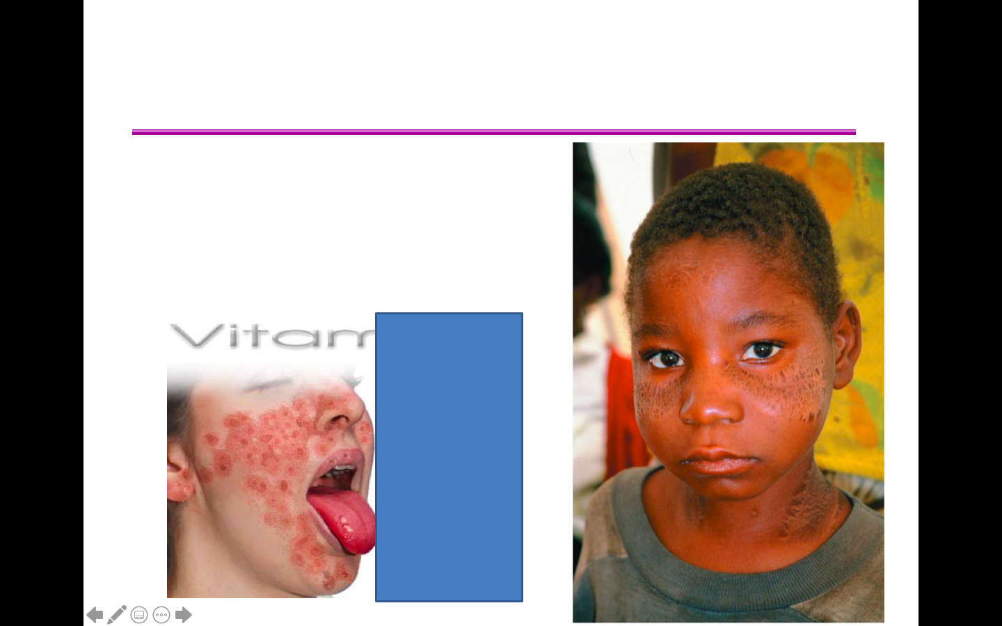 What is this and what is it caused by?
What nutrient deficiency can cause this?