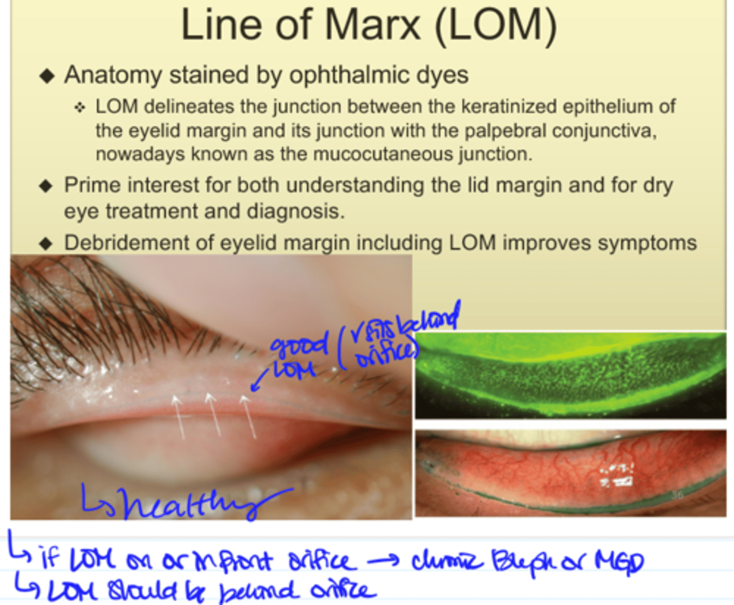 <p>- Anterior displacement of LOM --> ocular surface problem, not CL-induced</p><p>- LOM should be behind the orifices NOT in front</p>