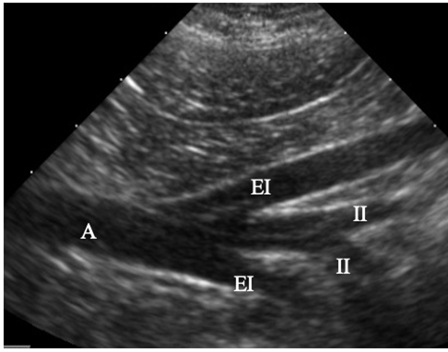 <p>ID vasculature on US</p>