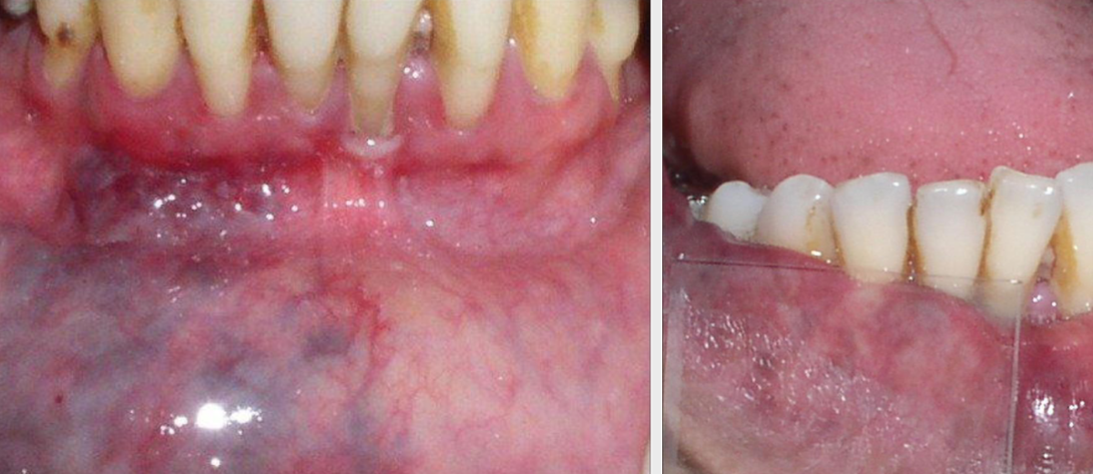 <p>procedure to examine skin lesions by blanching with pressure</p>