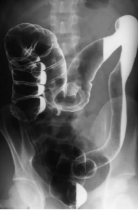 <p>Ulcerative colitis</p>