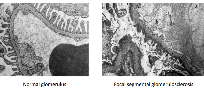 <p>Compare the podocyte processes in these electron microscopy images:</p><ul><li><p>Loss of normal podocyte architecture</p></li></ul><p></p>