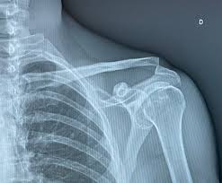 <p>Hallazgo clínico característico de ciertas luxaciones acromiovasculares (grado 3)</p><p>Cuando presionas hacia abajo la clavícula distal (en la articulación acromioclavicular) esta desciende, pero al soltarla vuelve a subir inmediatamente, como si fuera una tecla de piano.</p><p>¿Por qué ocurre?</p><p>Porque los ligamentos coracoclaviculares y/o acromioclaviculares están rotos, permitiendo que la clavícula quede elevada y móvil.</p><p>Qué indica</p><p>Sugiere inestabilidad importante en la articulación acromioclavicular.</p><p>Se asocia principalmente a luxación AC grado III o superior.</p>