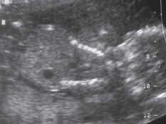 <ol><li><p>What is abnormal about this image?</p></li><li><p>This finding can be associated with what pathologies?</p></li></ol><p></p>