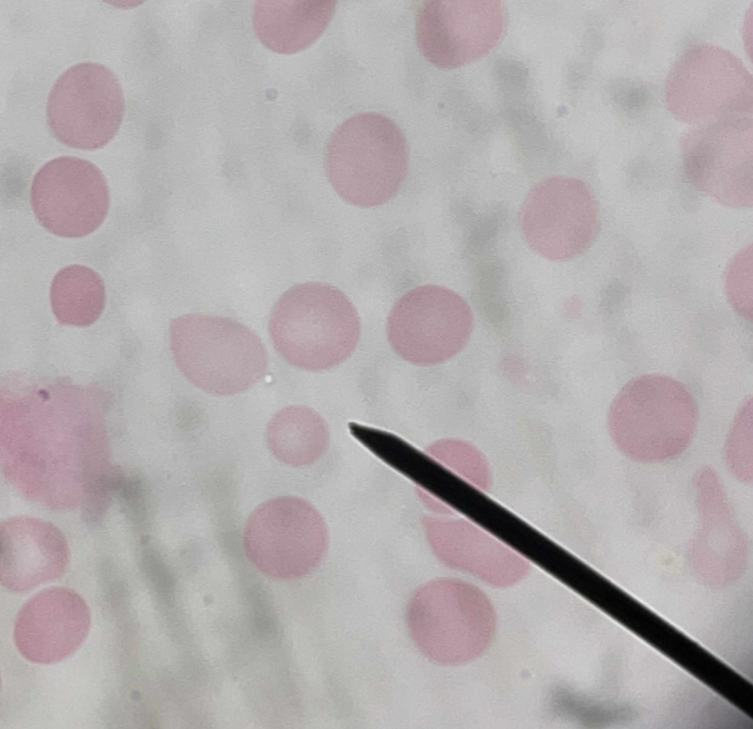 <p>A. Identify the pointed cell</p><p>B. Describe the striking feature</p><p>C. Associated with what condition?</p>