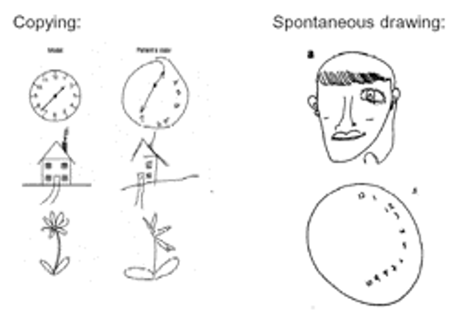 <p>usually damage to right dorsal PPC (typically right bc there is much more emphasis to right cortex for visual attention; js something i learned in a previous neuro class) --&gt; causes contralateral deficits<br>- left visual field neglect is most common</p>