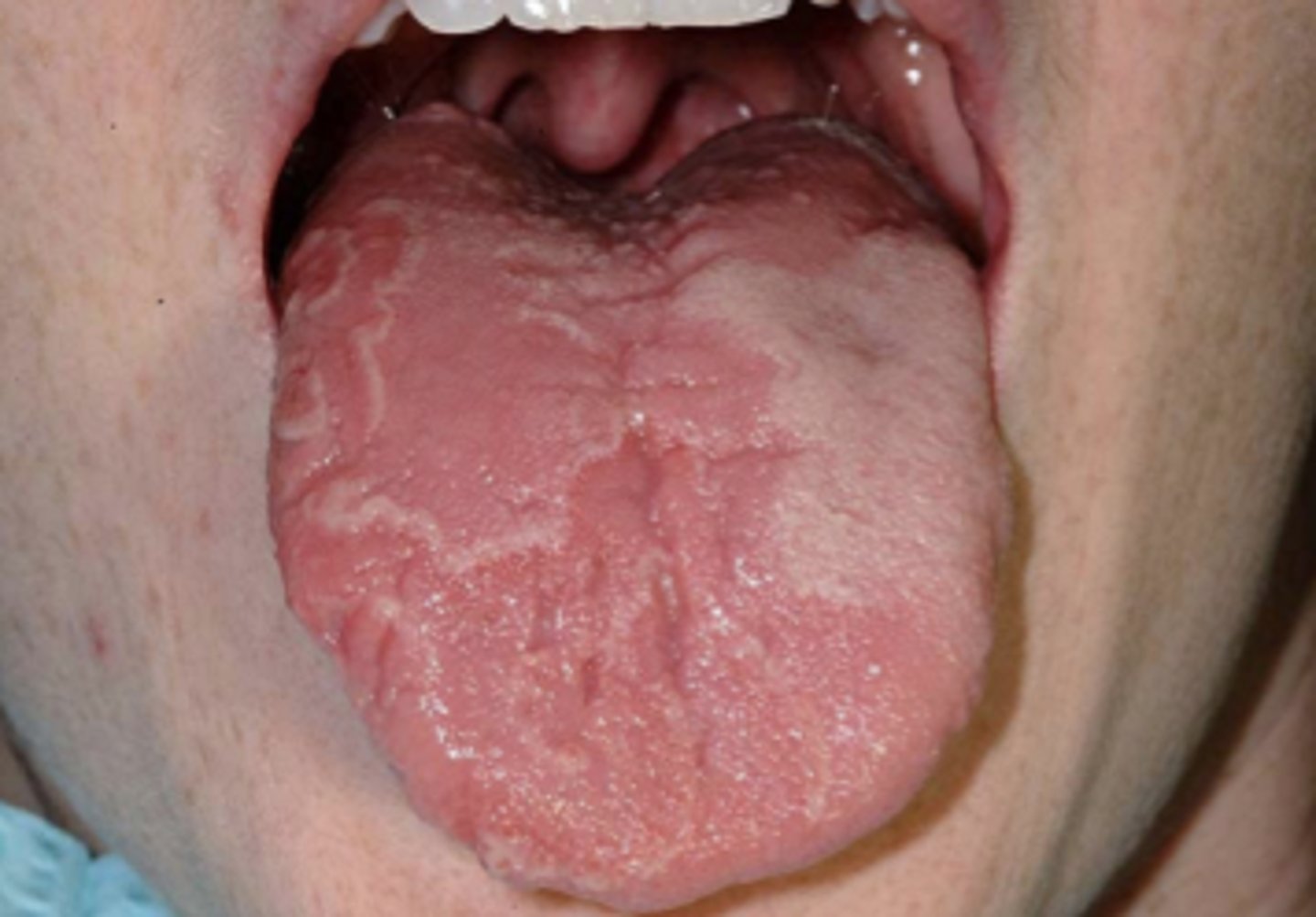 <p>inflammatory condition where patches of the tongue loses epithelium and papillae</p>