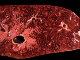 <p>interpret with GGT and CK to confirm liver vs muscle origin (if AST>4000U/L, likely from muscle)</p><p>-sensitive and stable</p><p>-peaks 24-48hrs, lasts up to 2 weeks</p><p>-can normalize with chronic dz</p>