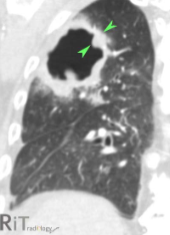 <p>Lung abscess </p>