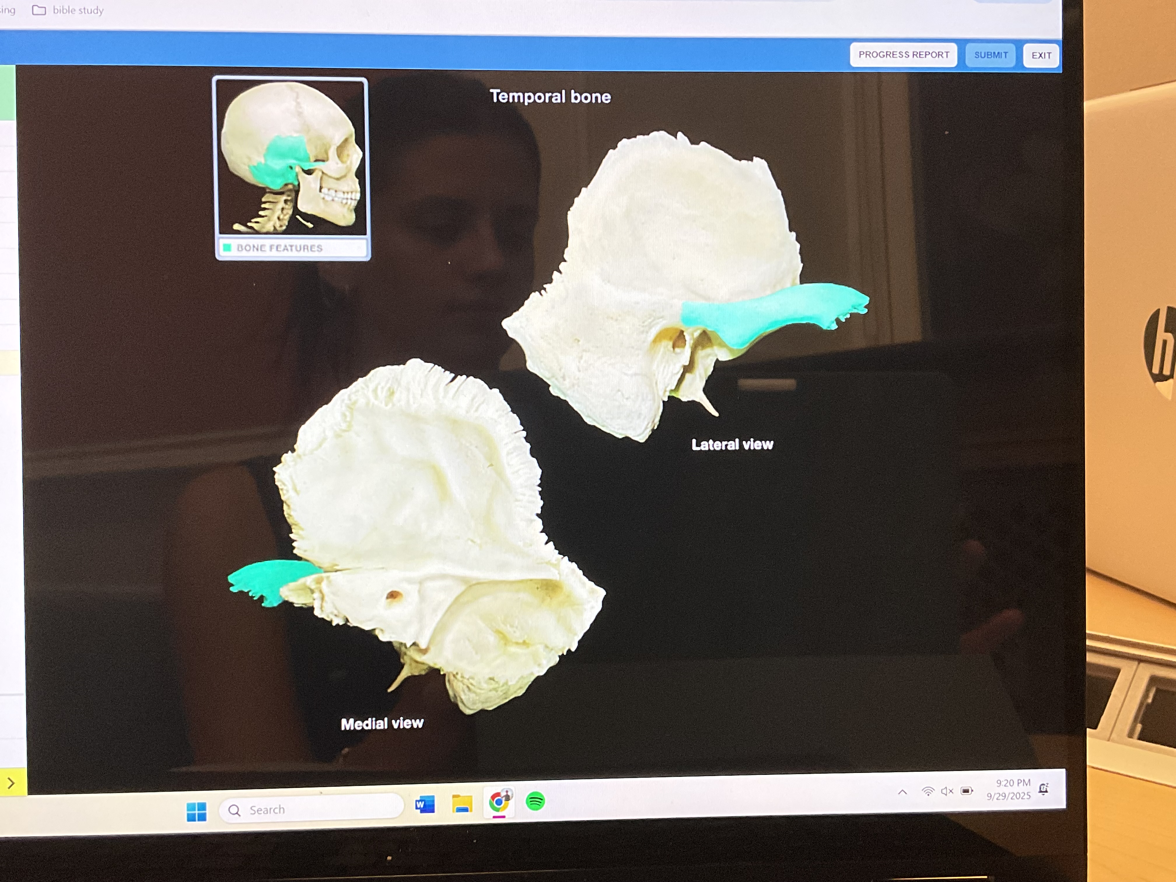 <p>Zygomatic process of temporal bone </p>