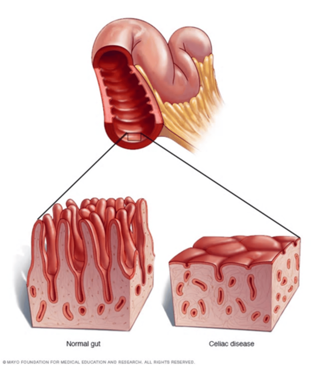 <p>a. Autoimmune disorder</p><p>b. Intolerant of gluten</p>