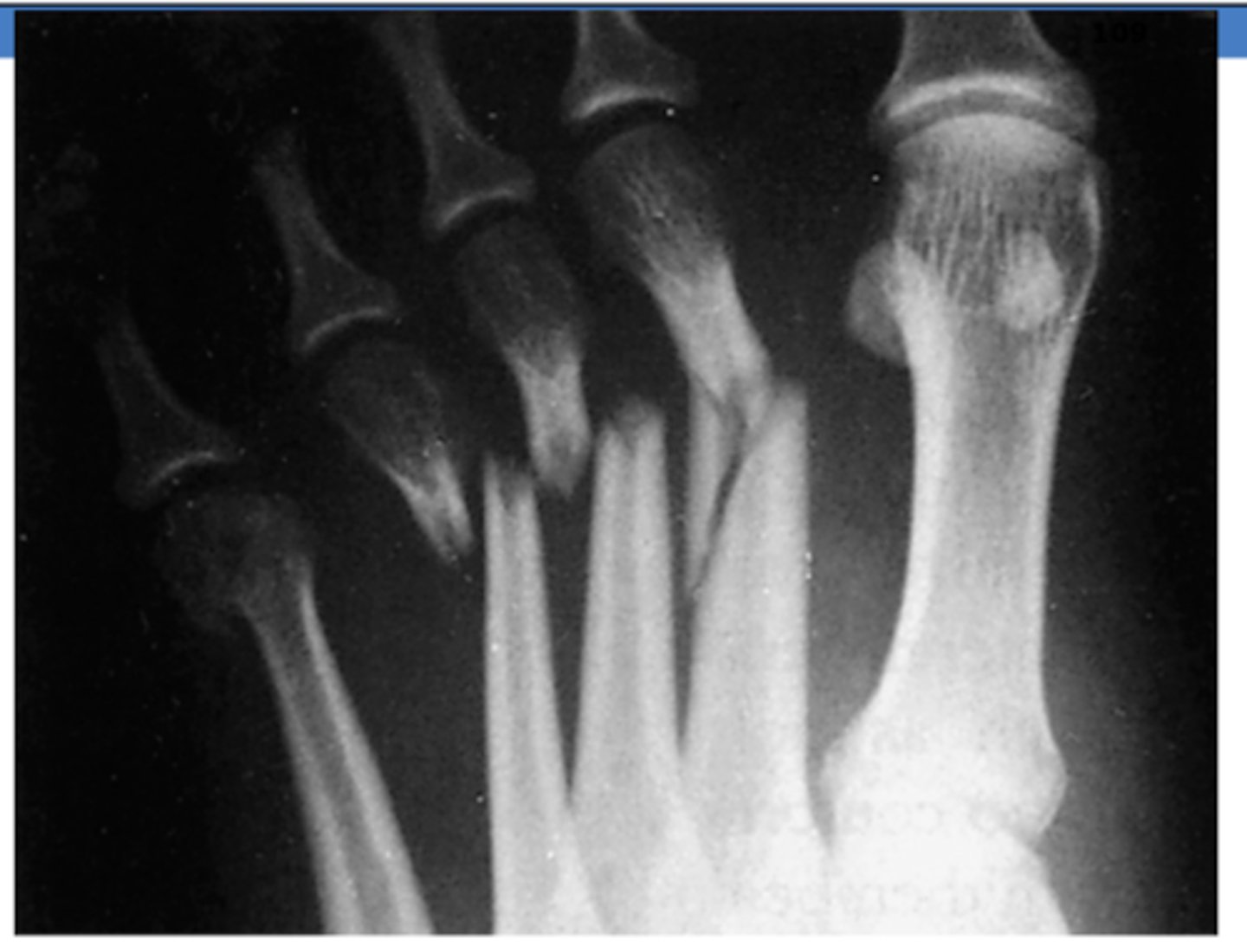<p>metatarsals</p>