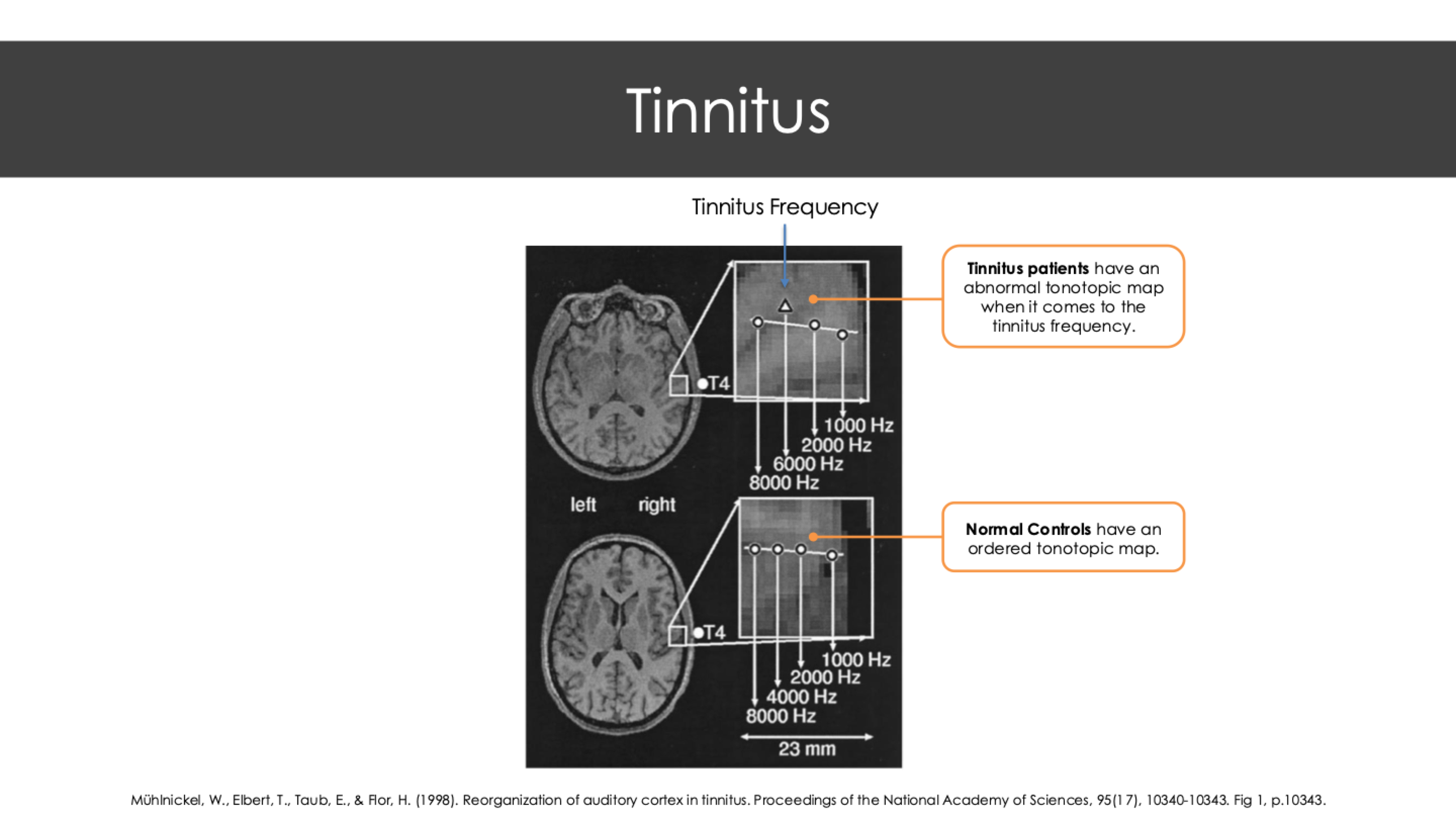 <ul><li><p>Sometimes temporary</p></li><li><p>If it persists can be corrected with surgery or hearing aids</p></li></ul><p></p><p>Because people with conductive deafness have a normal cochlea and auditory nerve, they readily hear their own voices, conducted through the bones of the skull directly to the cochlea, bypassing the middle ear. Because they hear themselves clearly, they may accuse others of talking too softly. </p><p></p>