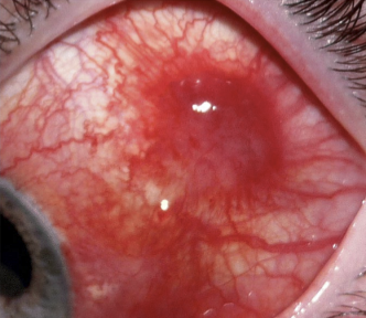 <p>A rare malignant tumor of the conjunctiva primarily affecting patients with AIDS.</p>
