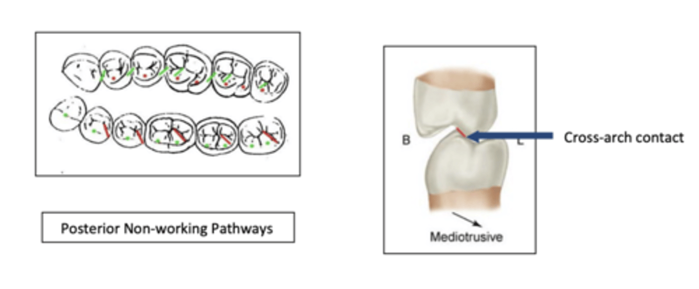 <p>occur on inner inclines of max lingual cusps and inner inclines of mand buccal cusps</p><p>cross arch contact</p><p>not desirable -- most destructive posterior contact</p>