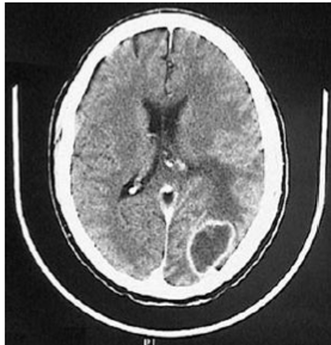 <p>Brain abscess 2/2 ethmoid sinusitis</p><p>- Head and neck infections: Viridans streptococcus (most common) and other anaerobic (prevotella, bacteroides)</p><p>- distant infections lung or endocarditis (staph aureus)</p><p>tx: surgical draining and aspiration, prolonged abx therapy (4-8 weeks)</p>