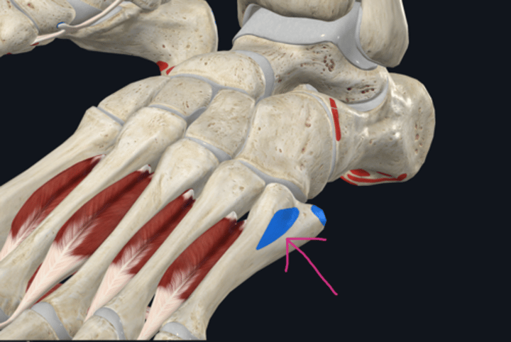 <p>Insertion: Peroneus Tertius</p>