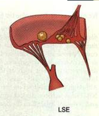 <p>form of nonbacterial endocarditis associated with systemic <strong>lupus </strong>erythematosus&nbsp;</p>