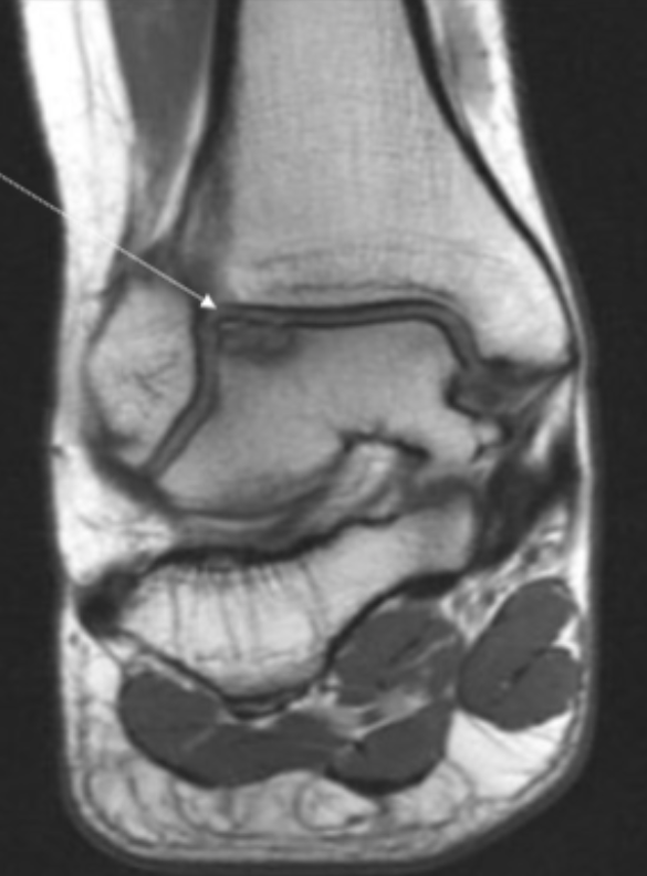 <p>Describe the pathology indicated by the arrow (Cor PD). </p>