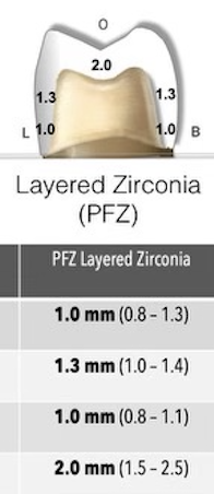 <ul><li><p>supragingival margins 0.65mm (0.1-1.0mm)</p></li><li><p>buccal gingival axial reduction 1.0mm (0.8-1.3mm)</p></li><li><p>lingual gingival axial reduction 1.0mm (0.8-1.1mm)</p></li><li><p>mid-axial reduction 1.3mm (1.0-1.4mm)</p></li><li><p>occlusal reduction 2.0mm (1.5-2.5mm)</p></li><li><p>wall taper 6-10 degrees (4-15 degrees)</p></li><li><p>marginal finish design SHOULDER rounded 90 degrees</p></li></ul>