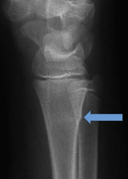 <p>What type of fracture is this? (Bonus points for full explanation)</p>