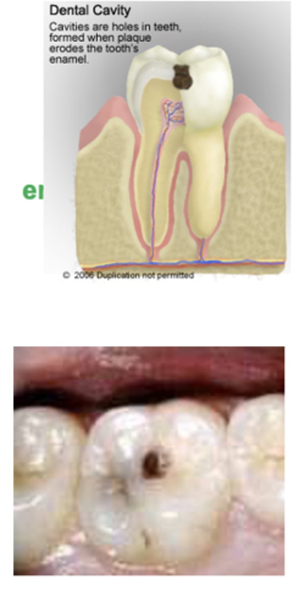 <p>Dental caries are <strong>result of bacterial metabolism</strong></p><p></p><p><span style="text-decoration:underline">Sugar is fermented</span></p><p>•Glucose, fructose, sucrose, lactose, maltose</p><p>•Acid by-product causes pH decrease</p><p>―<strong>Demineralization</strong> of tooth surface from enamel-coated crown to pulp of tooth</p>