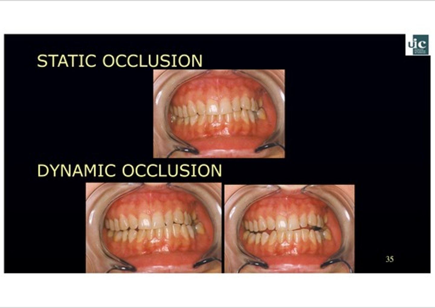 <p>How the teeth contact when the jaw moves OUT of centric position</p>