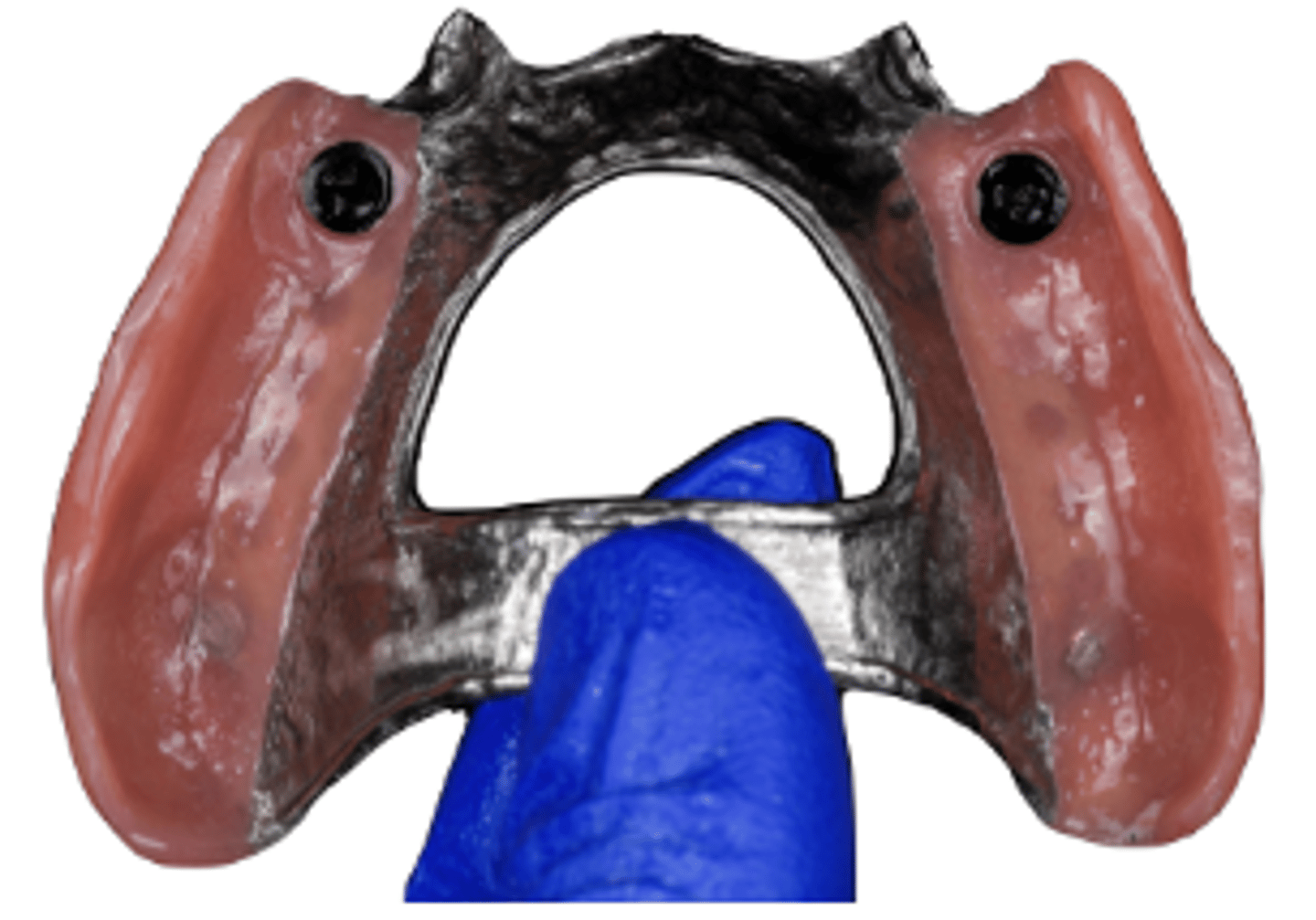 <p>What kind of implant dental prosthesis is shown in the image ? (Select one)</p><p>a. ISRPD (Implant supported removable partial denture)</p><p>b. IACD (implant assisted complete denture)</p><p>c. I-FDPs (implant supported fixed dental prosthesis)</p><p>d. I-SC (Implant supported crowns)</p><p>e. IARPD (Implant assisted removable partial denture)</p>