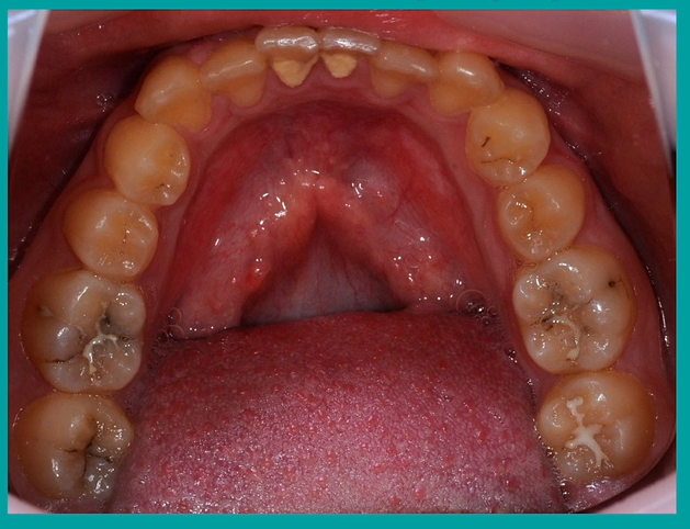 <p>spot the caries </p>