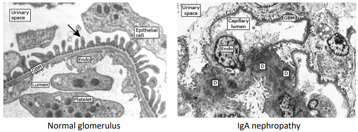 <p>Compare these electron microscopy images:</p><ul><li><p>Immune deposits (D) limited to mesangial regions</p></li><li><p>GBM appears normal</p></li></ul><p></p>