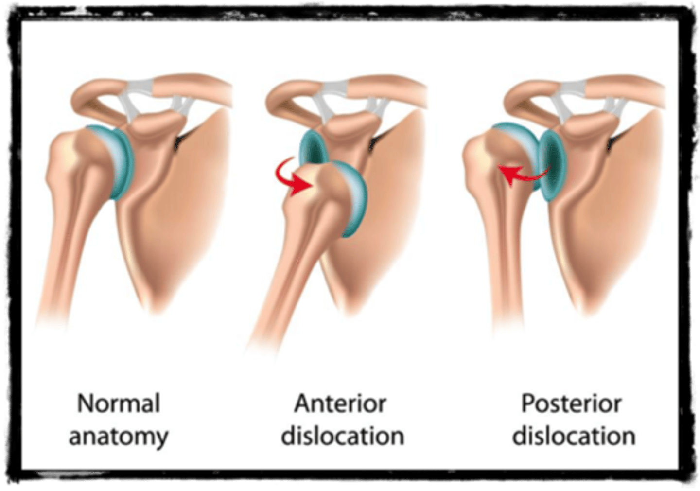 <p>the inferior part of the joint capsule is the weakest - it is not reinforced by rotator cuff muscle</p>