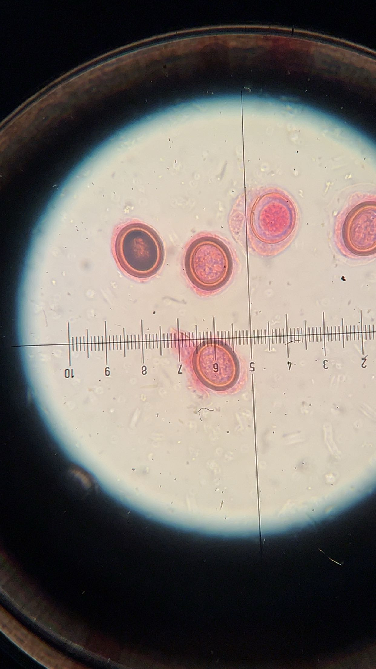 <p><em><span>Echinococcus granulosus</span></em><span> hydatid cyst</span></p>