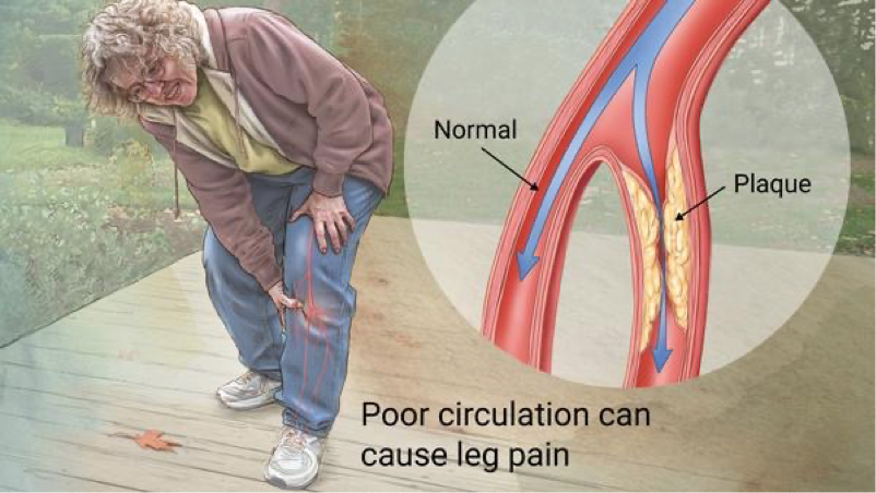 <p>Peripheral vascular disease</p>