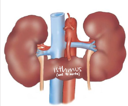 <p><mark data-color="yellow" style="background-color: yellow; color: inherit;">fusion of lower poles</mark>, connected via <u>isthmus</u> (anterior to spine and AO)</p>