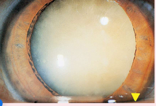 <p><span>Nuclear cataracts</span></p>