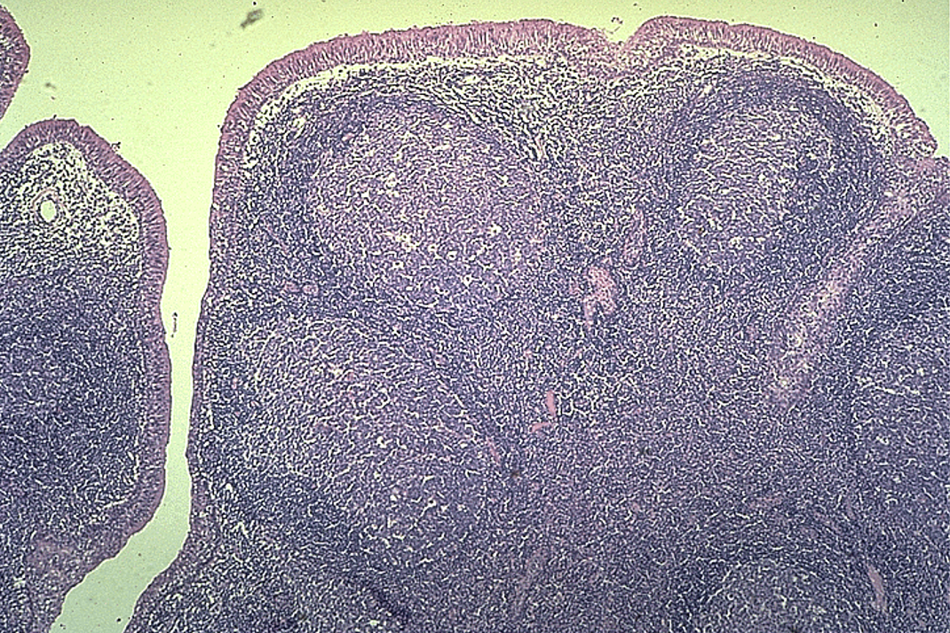 <p><strong>Tonsils </strong></p><p>Crypt and nodules w/ germinal centers observed</p>