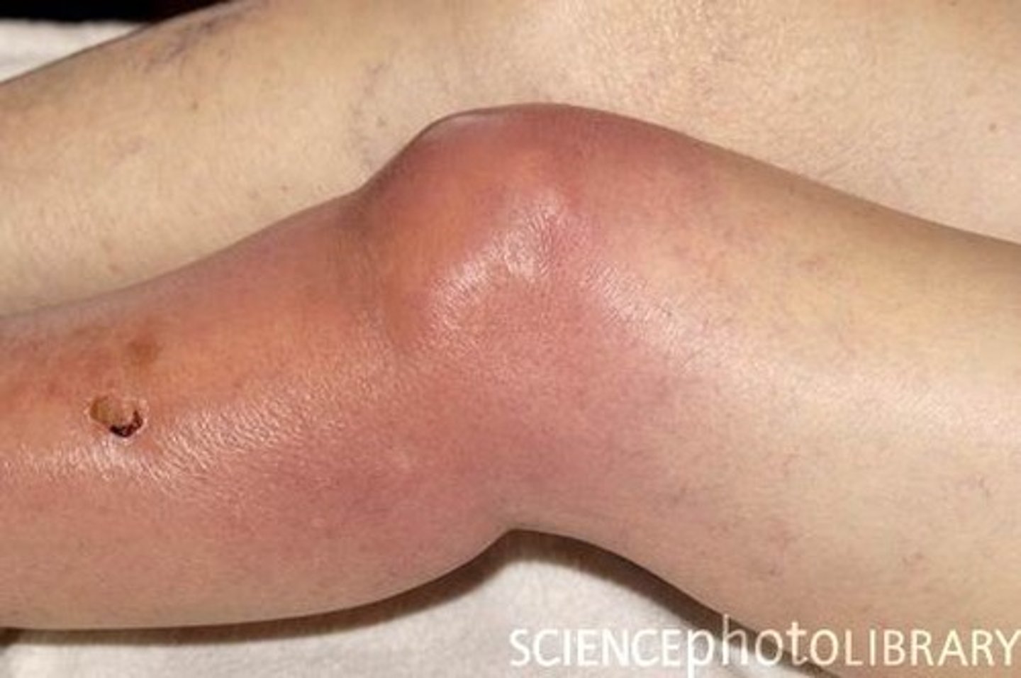 <p>palpable fluid beneath the skin indicative of infection or pus</p>