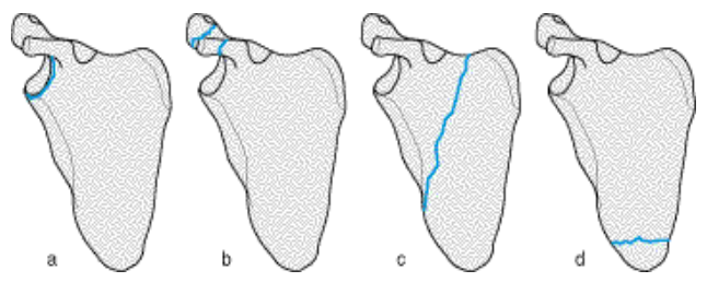 <p>Schulterblattfraktur - Scapulafraktur</p><ul><li><p>eher selten</p></li></ul><p></p>