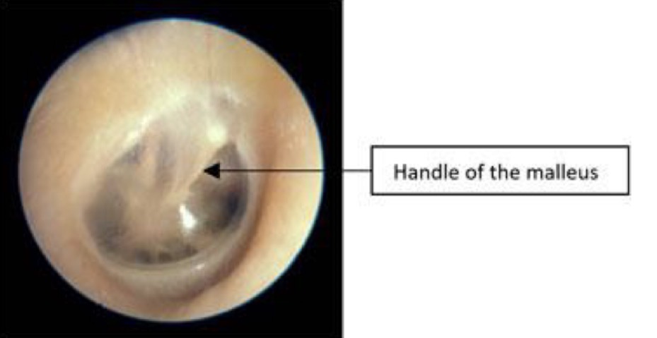 <p>Comment on this tympanic membrane</p>