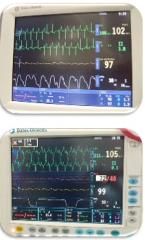 <ul><li><p>Can occur singly or in runs, or as ventricular tachycardia which may be paroxysmal</p></li></ul><p></p>