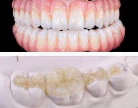 <p><span>Zirconia can be </span></p>