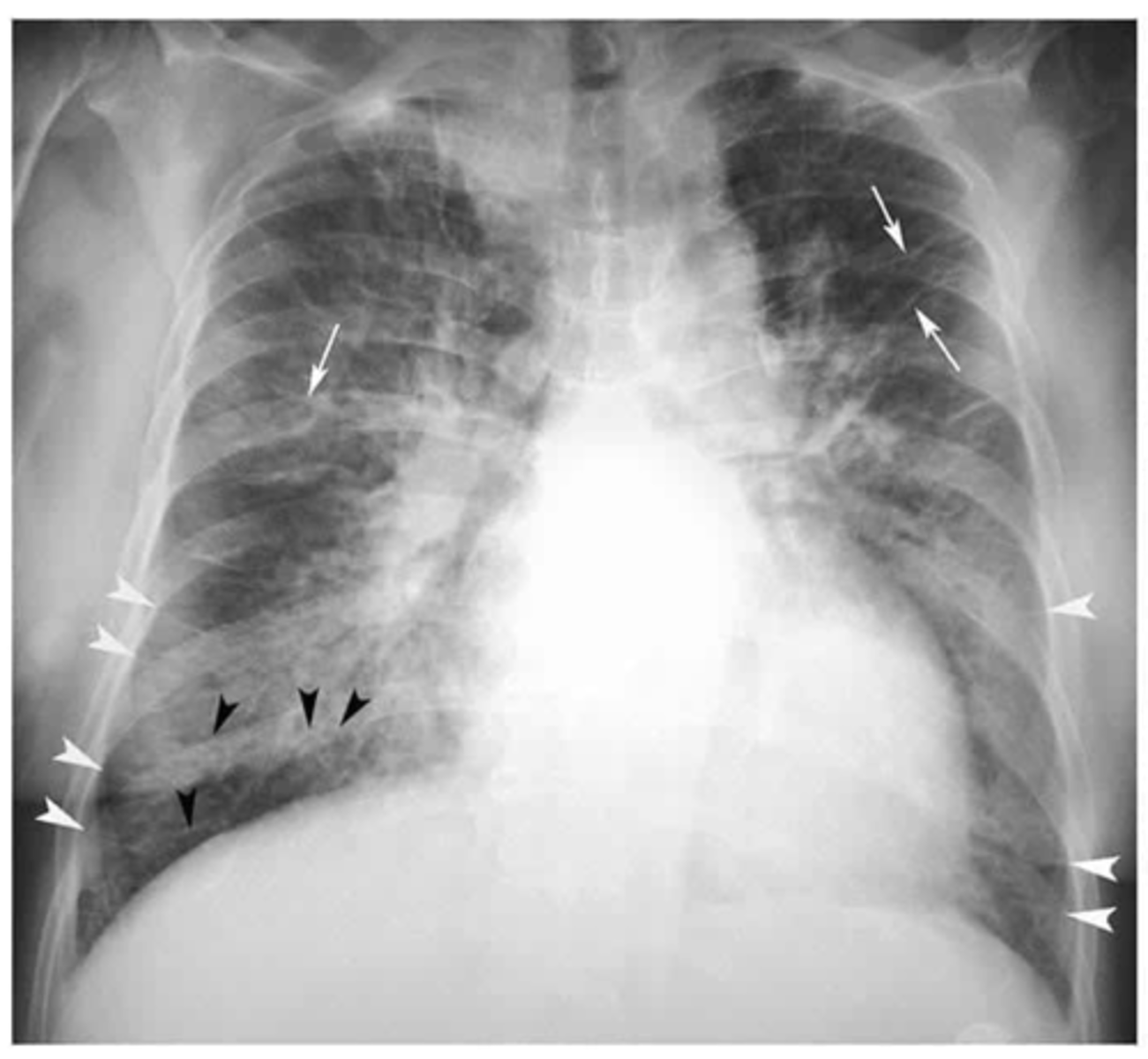 <p>What signs on radiograph indicate CHF?</p>