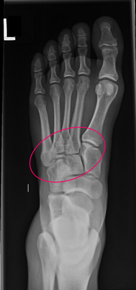 <p>open joints</p><ul><li><p>TMT joints</p></li><li><p>navicular-cuneiform joints</p></li></ul><p></p><p>excessive angle</p><ul><li><p>MTs elongated</p></li></ul><p></p><p>insufficient angle</p><ul><li><p>MTs foreshortened </p></li></ul><p></p>