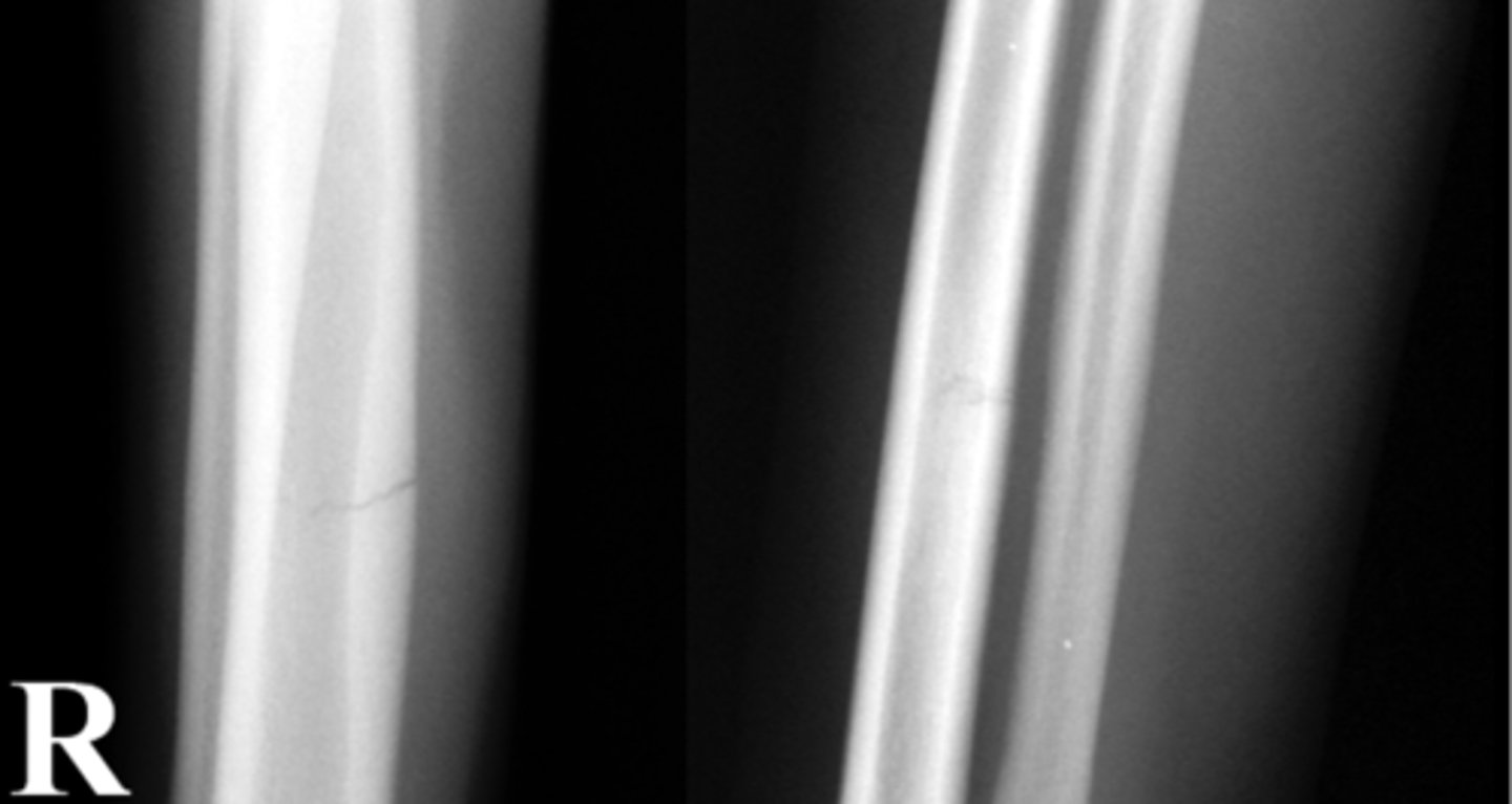 <p>Identify the fracture type?</p>