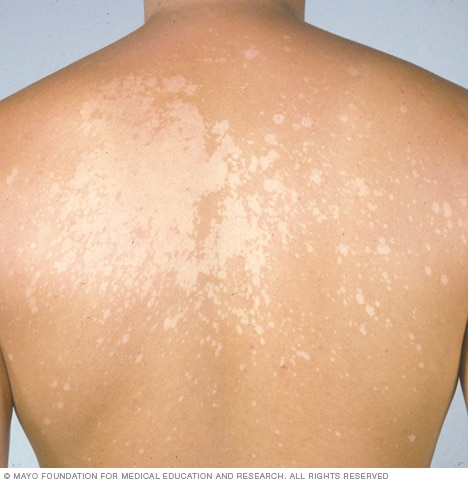 <p>PP: superficial malassezia infection<br>not contagious</p><p>E: malassezia furfur</p><p>CM: hyper/hypopigmented oval macules<br>fine scale on chest+back</p><p>TX: topical ketoconazole<br>topical selenium sulfide</p><p>P: 1-2 months for pigment to return to normal</p>