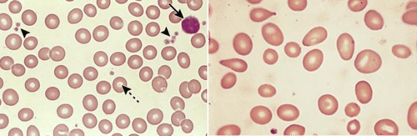 <p>macro-ovaloctye changes in RBCs is associated with a deficiency in what vitamin?</p>