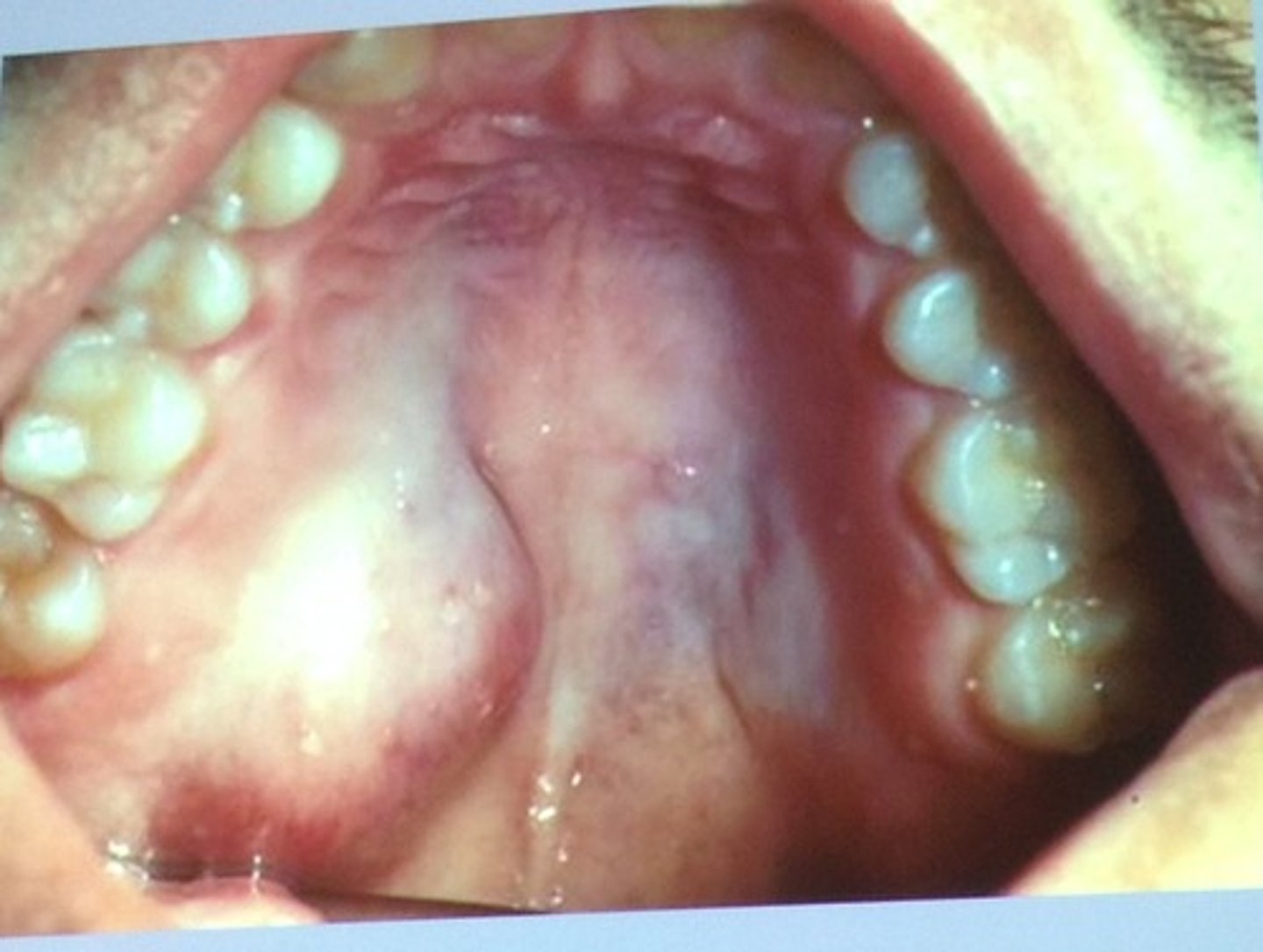 <p>~most common tumor of the salivary gland</p>